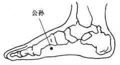 类风湿性关节炎的拔罐疗法